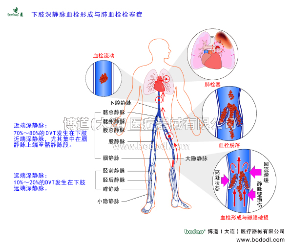 深靜脈血栓形成的預(yù)防與護(hù)理