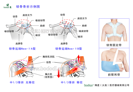 鎖骨的常見傷病與健康防護