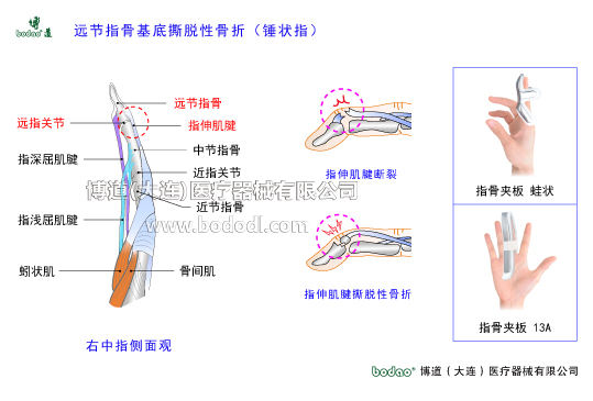 手關(guān)節(jié)常見傷病與健康防護