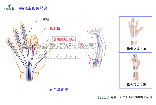 手關(guān)節(jié)常見傷病與健康防護