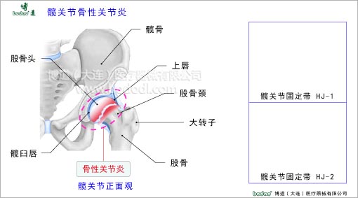 髖關(guān)節(jié)疾病與健康護(hù)理