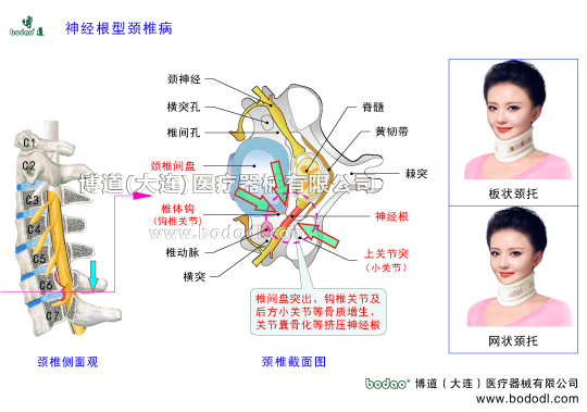 神經(jīng)根型頸椎病的病因、癥狀及防護(hù)治療，頸椎病的種類，頸椎綜合癥的治療與康復(fù)護(hù)理，神經(jīng)根型頸椎病的預(yù)防與治療博道透氣頸托頸椎固定帶頸椎間盤突出矯正支架鉤椎關(guān)節(jié)和頸椎小關(guān)節(jié)骨質(zhì)增生勞損骨刺形成小關(guān)節(jié)囊骨化鈣化關(guān)節(jié)突關(guān)節(jié)不穩(wěn)頸椎退行性病頸椎創(chuàng)傷性關(guān)節(jié)炎椎間孔狹小擠壓神經(jīng)根頸椎解剖構(gòu)造圖頸椎的構(gòu)造圍領(lǐng)護(hù)頸高度可調(diào)式頸椎固定支具頸椎骨折急救頸托頸神經(jīng)節(jié)椎動(dòng)脈椎