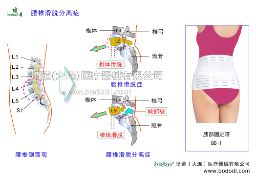 腰椎滑脫癥腰椎分離癥腰椎峽部裂腰椎滑脫分離癥腰椎峽部不連腰椎滑脫分離的主要癥狀與治療博道腰部固定帶醫(yī)用護腰腰椎軟骨退行性病變腰椎積累性損傷椎間孔狹窄壓迫神經根坐骨神經炎腰椎間盤突出癥髓核破裂椎弓椎體骶骨椎管神經根脊神經節(jié)前縱韌帶后縱韌帶椎間關節(jié)馬尾綜合征關節(jié)突關節(jié)變形腰肌勞損腰背肌筋膜炎腰骶部慢性損傷閃腰急性腰扭傷腰椎的結構解剖腰骶關節(jié)勞損骶髂關節(jié)炎馬尾綜合癥腰椎固定帶腰圍第四第五腰椎滑脫第一骶椎博
