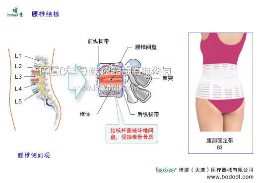 腰椎結核龜背炎的發(fā)病原因及治療方法與康復護理。腰椎結核的癥狀與治療，博道醫(yī)用透氣性腰部固定帶腰椎矯正帶。脊椎椎體以松質骨為主結核菌，寒性膿腫結核膿腫肉芽組織椎間盤壞死，上腰椎結核可有大腿痛，下腰椎結核可有放射狀的坐骨神經痛。腰部強直腰椎關節(jié)活動受限，出現(xiàn)成角后凸畸形強直性脊柱炎化膿性脊柱炎腰椎間盤突出。脊柱腫瘤退行性脊椎骨關節(jié)病以腰部固定帶等護腰支具固定為輔，透氣護腰帶腰圍腰托腰椎固定支具腰疼帶