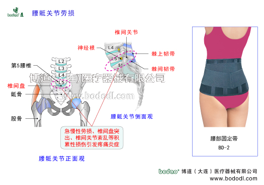腰骶關節(jié)勞損腰骶關節(jié)炎的癥狀與治療腰骶關節(jié)在哪里腰骶關節(jié)形成角度120°是活動性腰椎轉變?yōu)楣潭ㄐ憎咀登巴寡缔D變?yōu)楹笸棍咀档倪^渡區(qū)中心。博道腰部固定帶透氣性醫(yī)用護腰。慢性腰骶關節(jié)勞損的發(fā)病原因豎脊肌臀大肌腰骶關節(jié)腰椎間盤腰椎小關節(jié)韌帶擠壓椎間盤韌帶損傷撕裂腰椎滑脫分離峽部裂關節(jié)突骨折椎間盤突出骶髂關節(jié)下肢關節(jié)骶髂關節(jié)韌帶松弛骶棘肌腰骶棘間韌帶腰骶關節(jié)突腰扭傷勞損增生腰椎間盤突出骨質疏松退行性病變密切