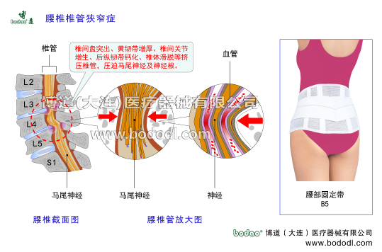 腰椎椎管狹窄癥的主要癥狀與治療博道醫(yī)用護腰腰部固定帶。腰椎間盤突出、腰椎骨質增生、黃韌帶增厚腰椎小關節(jié)增生椎間關節(jié)退變關節(jié)突關節(jié)不穩(wěn)腰椎滑脫分離腰椎峽部裂等擠壓椎管脊髓馬尾神經及腰椎神經腰椎軟骨退行性病變腰椎積累性損傷腰椎出血滲出鈣化骨橋導致椎間孔狹窄壓迫神經根而發(fā)病，導致坐骨神經炎。腰肌勞損髓核破裂突出椎間關節(jié)增生變形引發(fā)馬尾綜合征腰椎固定帶腰椎部主要病癥腰椎管結構解剖圖腰椎小關節(jié)增生腰骶關節(jié)勞損