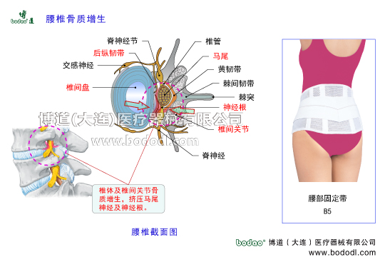 腰椎骨質增生及其主要癥狀、腰椎增生的發(fā)病原因及治療與防護腰椎骨刺形成腰椎軟骨退行性病變及腰椎間盤膨出腰椎積累性損傷導致腰椎增生博道醫(yī)用護腰部固定帶的主要功能腰椎出血滲出鈣化唇樣骨質增生骨橋椎間孔狹窄擠壓神經根引發(fā)坐骨神經炎，腰椎勞損神經根交感神經脊神經節(jié)前縱韌帶后縱韌帶黃韌帶棘間韌帶棘上韌帶腰椎小關節(jié)囊椎間關節(jié)變形腰部軟組織勞損腰骶部慢性損傷腰椎部主要病癥閃腰急性筋膜損傷腰椎的構造腰骶關節(jié)勞損馬尾神