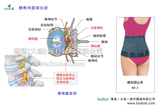腰椎間盤突出癥的主要癥狀與治療博道醫(yī)用護腰椎固定帶腰椎退行性改變腰椎勞損髓核破裂突出椎管神經根脊神經節(jié)交感神經馬尾神經前縱韌帶后縱韌帶棘間韌帶腰椎椎間關節(jié)增生椎間盤膨出椎間盤退變馬尾綜合征關節(jié)突關節(jié)變形腰肌勞損腰背肌筋膜炎腰椎部及腰骶部軟組織慢性勞損腰椎間盤退化急性腰背肌筋膜損傷腰椎的構造解剖圖腰椎小關節(jié)紊亂腰部固定帶透氣護腰帶腰圍腰托腰椎矯正固定牽引支具腰椎矯正器腰椎固定支具腰疼帶博道護腰透氣護腰