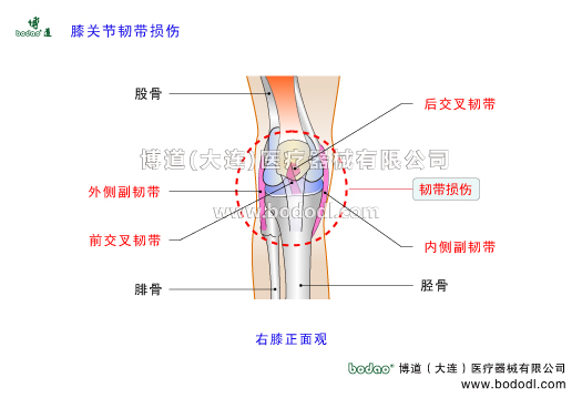 膝關(guān)節(jié)韌帶損傷膝關(guān)節(jié)韌帶的構(gòu)造與作用內(nèi)側(cè)副韌帶MCL外側(cè)副韌帶LCL前后交叉韌帶前后十字韌帶ACL損傷PCL損傷。博道膝關(guān)節(jié)固定帶醫(yī)用護(hù)膝膝關(guān)節(jié)角度可調(diào)式卡盤固定支架膝關(guān)節(jié)韌帶撕脫性骨折固定夾板透氣性加壓護(hù)膝。膝關(guān)節(jié)韌帶是膝關(guān)節(jié)重要穩(wěn)定因素具有限制和制導(dǎo)功能當(dāng)韌帶承受的應(yīng)力超過其完全斷裂的屈服點(diǎn)后則發(fā)生韌帶部分?jǐn)嗔淹耆珨嗔押吐?lián)合性損傷等撕裂損傷韌帶損傷類型和部位撕脫性骨折。