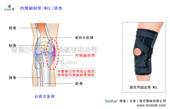 膝關(guān)節(jié)內(nèi)側(cè)副韌帶MCL的構(gòu)造與功能，膝內(nèi)側(cè)副韌帶損傷的原因與康復(fù)治療，博道膝關(guān)節(jié)軟組織損傷固定矯正支架O型膝內(nèi)翻X型腿膝外翻矯正固定護(hù)膝哪個(gè)好，膝關(guān)節(jié)內(nèi)側(cè)外側(cè)半月板損傷斷裂固定護(hù)膝，半月板損傷斷裂治療與術(shù)后固定。博道內(nèi)側(cè)副韌帶MCL固定帶MCL加壓護(hù)膝排行榜，膝關(guān)節(jié)MCL損傷術(shù)后固定與康復(fù)護(hù)理，MCL內(nèi)側(cè)副韌帶損傷防護(hù)固定夾板MCL內(nèi)側(cè)副韌帶重建固定矯正支架，內(nèi)側(cè)副韌帶損傷可調(diào)節(jié)式固定護(hù)膝夾板哪個(gè)好
