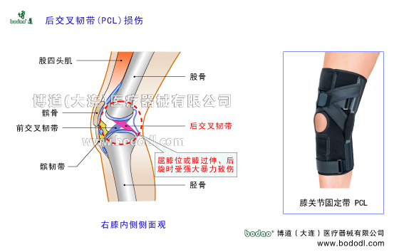 膝關(guān)節(jié)后交叉韌帶PCL的構(gòu)造與功能。后交叉韌帶損傷的原因、癥狀及治療方法。博道后交叉韌帶損傷加壓固定帶日本透氣護(hù)膝膝關(guān)節(jié)PCL后交叉韌帶損傷斷裂的主要癥狀與康復(fù)治療。可調(diào)式膝關(guān)節(jié)韌帶固定支架膝關(guān)節(jié)軟組織損傷固定夾板膝關(guān)節(jié)增生性關(guān)節(jié)炎膝關(guān)節(jié)損傷的防護(hù)與術(shù)后固定護(hù)理博道透氣性加壓護(hù)膝后十字韌帶損傷醫(yī)用固定帶PCL損傷固定帶膝關(guān)節(jié)的構(gòu)造PCL后交叉韌帶后十字韌帶重建固定膝關(guān)節(jié)疾病的預(yù)防與治療膝關(guān)節(jié)疾病的治