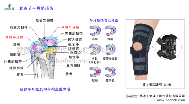 膝關(guān)節(jié)半月板損傷膝關(guān)節(jié)半月板及韌帶構(gòu)造。膝關(guān)節(jié)韌帶半月板關(guān)節(jié)囊滑膜骨骼解剖圖。半月板損傷分型。博道膝關(guān)節(jié)可調(diào)節(jié)式卡盤固定支架膝關(guān)節(jié)骨折可調(diào)式固定支架CL-H內(nèi)側(cè)半月板外側(cè)半月板及韌帶構(gòu)造髕韌帶髕下脂肪墊翼狀皺襞髕下滑膜皺襞脛骨粗隆脛骨外側(cè)副韌帶腘肌腱腓骨膝橫韌帶后交叉韌帶內(nèi)側(cè)副韌帶膝關(guān)節(jié)囊膝關(guān)節(jié)滑膜前交叉韌帶半月板損傷的原因、癥狀及治療方法。可調(diào)式膝關(guān)節(jié)固定帶腿部下肢骨折固定夾板半月板損傷的主要癥狀