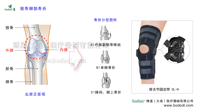 股骨髁部骨折，膝關(guān)節(jié)的結(jié)構(gòu)，博道角度可調(diào)式卡盤固定支架，膝關(guān)節(jié)內(nèi)骨折的分類及特點(diǎn)，博道醫(yī)用護(hù)膝CL-H股骨髁部骨折的原因、癥狀與術(shù)后治療固定支架，膝關(guān)節(jié)股骨骨折的原因、癥狀、分型與康復(fù)治療。膝關(guān)節(jié)置換固定支架腿部下肢骨折固定夾板，膝關(guān)節(jié)損傷固定支具。膝關(guān)節(jié)區(qū)域骨折專業(yè)固定支架、膝關(guān)節(jié)韌帶重建術(shù)后固定帶、股骨髁部骨折危害脛骨平臺(tái)和髕股關(guān)節(jié)改變膝關(guān)節(jié)正常的解剖軸與機(jī)械軸，導(dǎo)致伸膝裝置粘連、創(chuàng)傷性膝關(guān)節(jié)炎