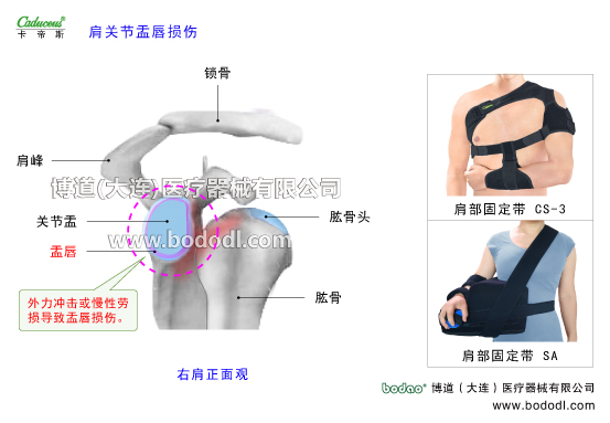 肩關(guān)節(jié)的運動損傷與防護