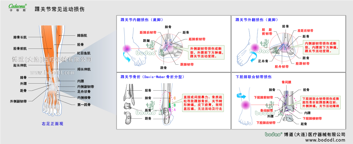 踝關(guān)節(jié)運(yùn)動(dòng)損傷的類型與癥狀