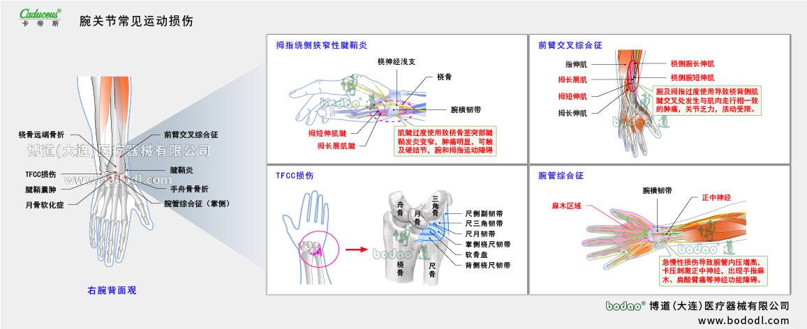 腕關(guān)節(jié)運動損傷的類型與癥狀