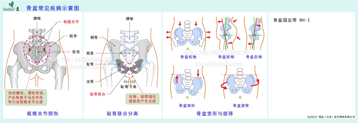 骨盆常見(jiàn)疾病示意圖
