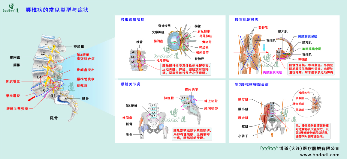 腰椎病的類型與癥狀