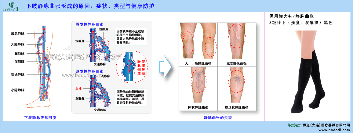 下肢靜脈曲張與健康防護(hù)